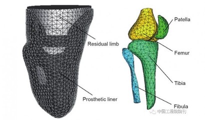 增材制造技术 假肢与矫形器领域的个性化革新