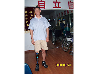 青岛市远征假肢矫形器 专业假肢与矫形器的选择与服务